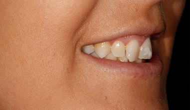 Before - Natural Smiles Implant & Cosmetic Dentistry