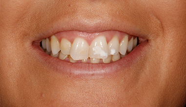 Before - Natural Smiles Implant & Cosmetic Dentistry