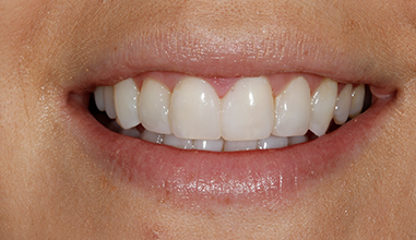 After - Natural Smiles Implant & Cosmetic Dentistry
