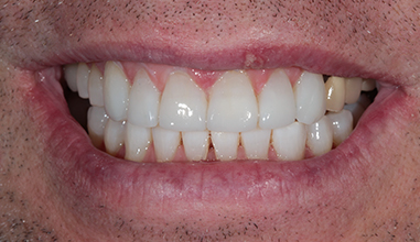 After - Natural Smiles Implant & Cosmetic Dentistry