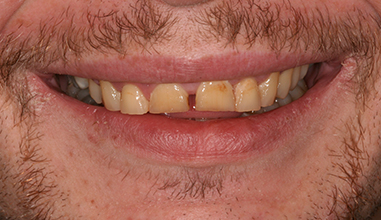 Before - Natural Smiles Implant & Cosmetic Dentistry