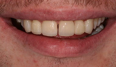 After - Natural Smiles Implant & Cosmetic Dentistry