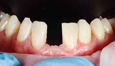 Before - Natural Smiles Implant & Cosmetic Dentistry