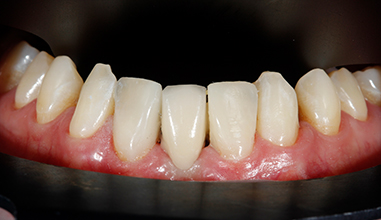 After - Natural Smiles Implant & Cosmetic Dentistry