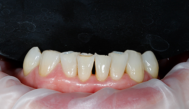 Before - Natural Smiles Implant & Cosmetic Dentistry