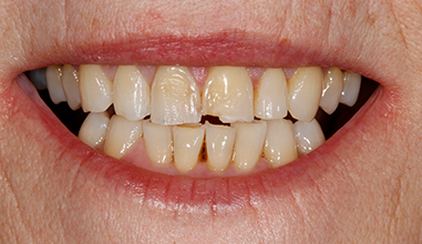 Before - Natural Smiles Implant & Cosmetic Dentistry