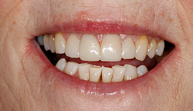 After - Natural Smiles Implant & Cosmetic Dentistry