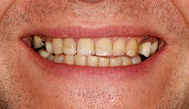 Before - Natural Smiles Implant & Cosmetic Dentistry