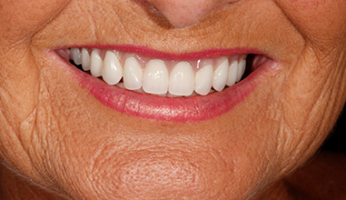 After - Natural Smiles Implant & Cosmetic Dentistry