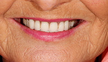 Before - Natural Smiles Implant & Cosmetic Dentistry