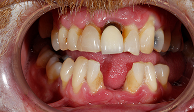Before - Natural Smiles Implant & Cosmetic Dentistry