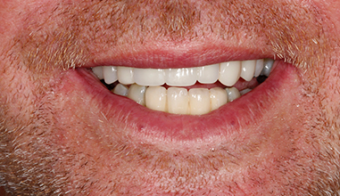 After - Natural Smiles Implant & Cosmetic Dentistry