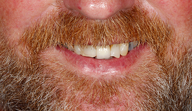 Before - Natural Smiles Implant & Cosmetic Dentistry
