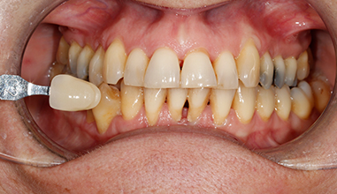Before - Natural Smiles Implant & Cosmetic Dentistry