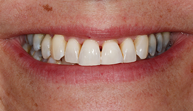 After - Natural Smiles Implant & Cosmetic Dentistry