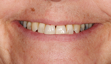 Before - Natural Smiles Implant & Cosmetic Dentistry