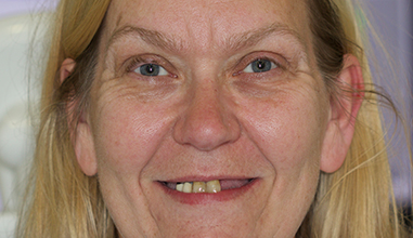 Before - Natural Smiles Implant & Cosmetic Dentistry