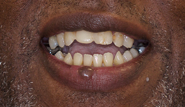 Before - Natural Smiles Implant & Cosmetic Dentistry