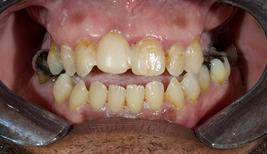 Before - Natural Smiles Implant & Cosmetic Dentistry