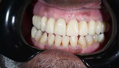 After - Natural Smiles Implant & Cosmetic Dentistry