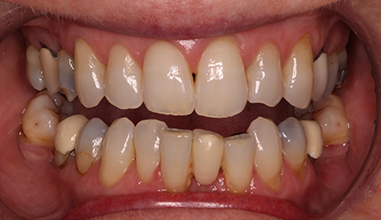 Before - Natural Smiles Implant & Cosmetic Dentistry
