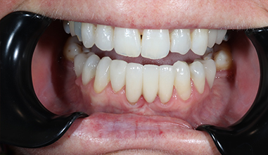 After - Natural Smiles Implant & Cosmetic Dentistry