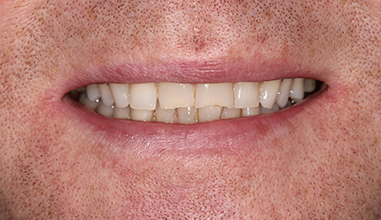 Before - Natural Smiles Implant & Cosmetic Dentistry