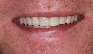 After - Natural Smiles Implant & Cosmetic Dentistry