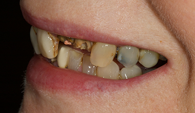 Before - Natural Smiles Implant & Cosmetic Dentistry