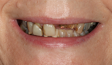 Before - Natural Smiles Implant & Cosmetic Dentistry
