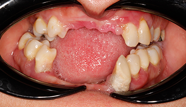 Before - Natural Smiles Implant & Cosmetic Dentistry