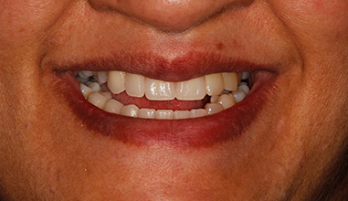 After - Natural Smiles Implant & Cosmetic Dentistry