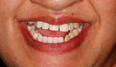 Before - Natural Smiles Implant & Cosmetic Dentistry