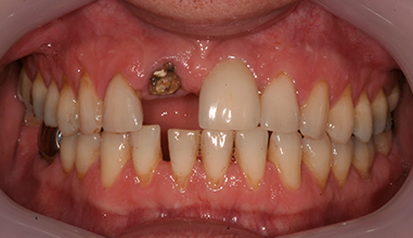 Before - Natural Smiles Implant & Cosmetic Dentistry