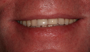 After - Natural Smiles Implant & Cosmetic Dentistry