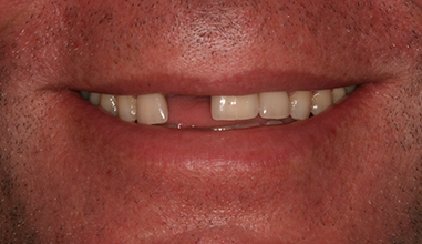 Before - Natural Smiles Implant & Cosmetic Dentistry