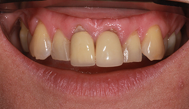 After - Natural Smiles Implant & Cosmetic Dentistry