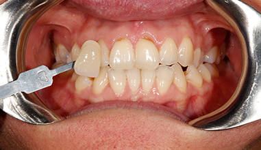 Before - Natural Smiles Implant & Cosmetic Dentistry