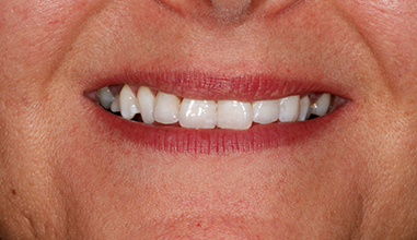 After - Natural Smiles Implant & Cosmetic Dentistry