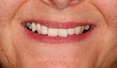 Before - Natural Smiles Implant & Cosmetic Dentistry