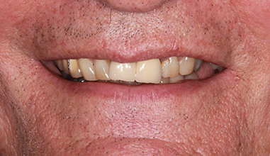 Before - Natural Smiles Implant & Cosmetic Dentistry