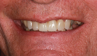 After - Natural Smiles Implant & Cosmetic Dentistry