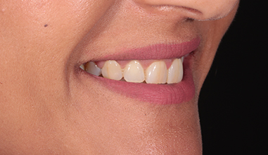 Before - Natural Smiles Implant & Cosmetic Dentistry