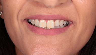 Before - Natural Smiles Implant & Cosmetic Dentistry