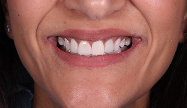After - Natural Smiles Implant & Cosmetic Dentistry