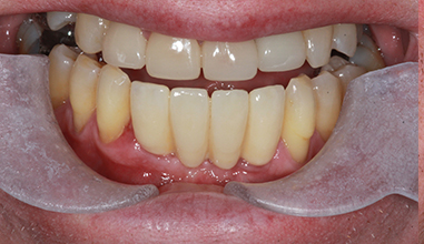 Before - Natural Smiles Implant & Cosmetic Dentistry