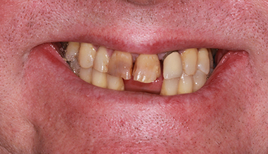 Before - Natural Smiles Implant & Cosmetic Dentistry