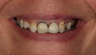 Before - Natural Smiles Implant & Cosmetic Dentistry