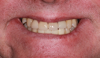 After - Natural Smiles Implant & Cosmetic Dentistry