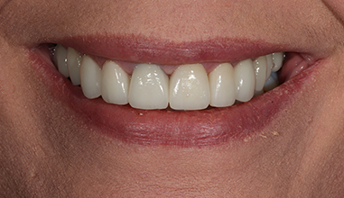 After - Natural Smiles Implant & Cosmetic Dentistry